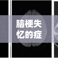 脑梗失忆的症状与原因，专业解析助您了解记忆恢复之路