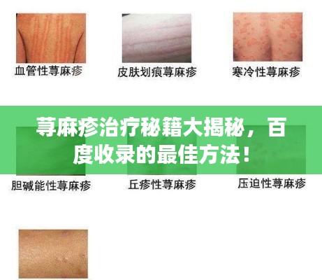 荨麻疹治疗秘籍大揭秘，百度收录的最佳方法！