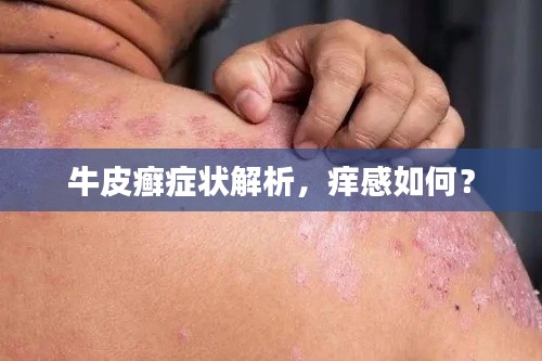 牛皮癣症状解析，痒感如何？